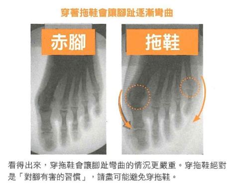 踩鞋後跟禁忌|在家穿「拖鞋」，其實很傷腳！物理治療師一次整理「對腳有害」。